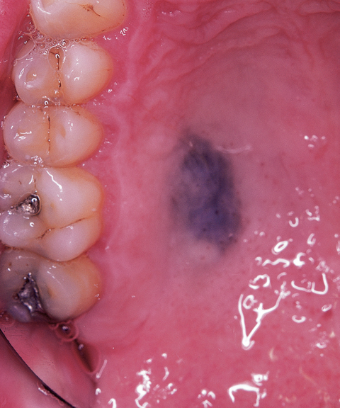 Oral Pathology Exam 2 Pigmented Lesions Lecture Packet Images