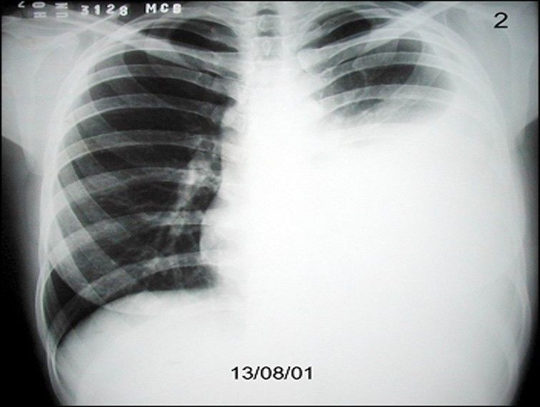 Semiologia Respirat Ria Flashcards