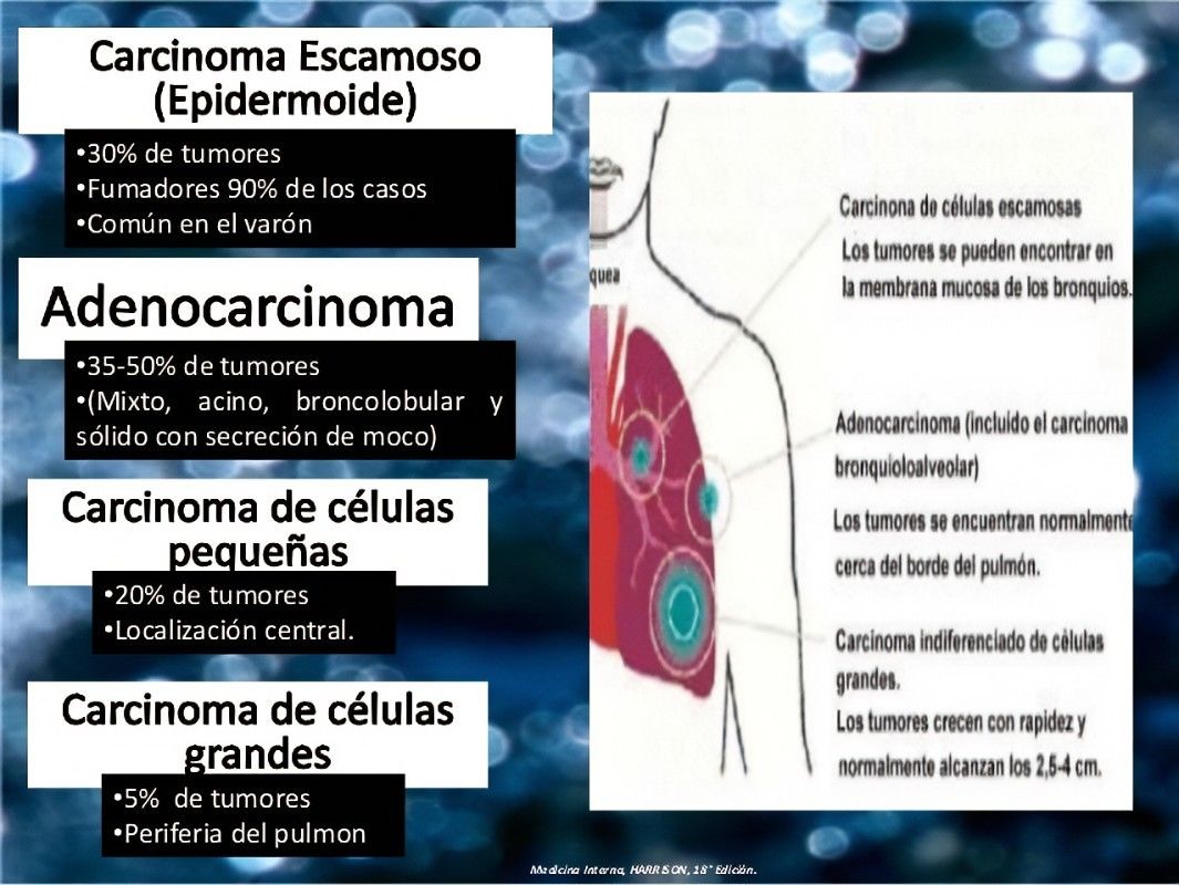 CLASIFICACIÓN DE LAS NEOPLASIAS DEL PULMÓN Mind Map