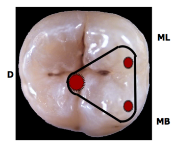 Access Cavities | Flashcards