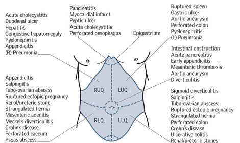 Alimentary System: Acute Abdomen | Flashcards