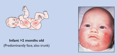 Paediatrics: Immunology, Allergy and Dermatology (Eczema and Nappy Rash ...