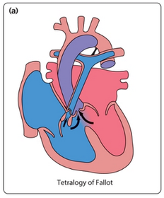 Paediatrics: Heart and Cardiovascular | Flashcards