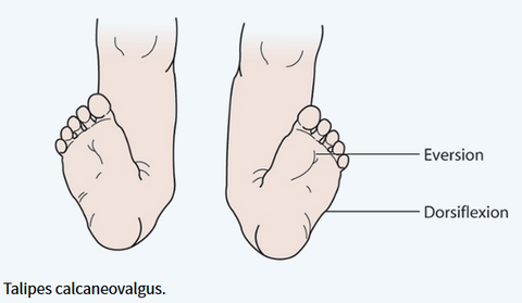 Paediatrics: Neonatology (Developmental Dysplasia of the Hip and ...