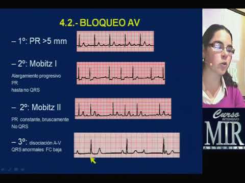 interpretación del electrocardiograma