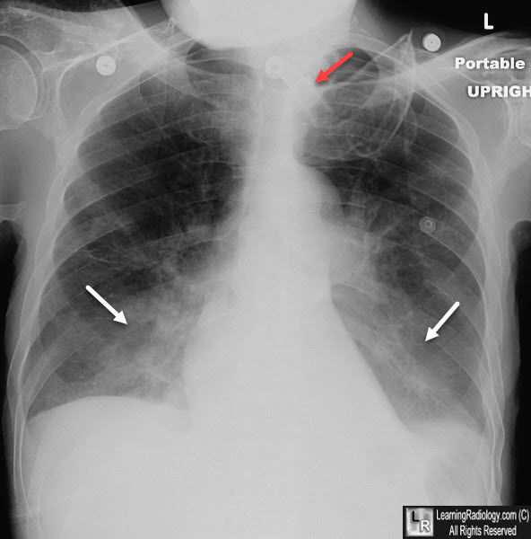 Chest Pathologies and Appearances | Flashcards