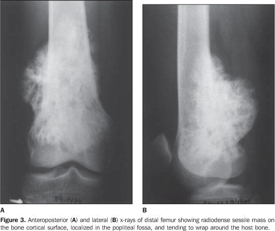 Miscellaneous bone pathologies | Flashcards