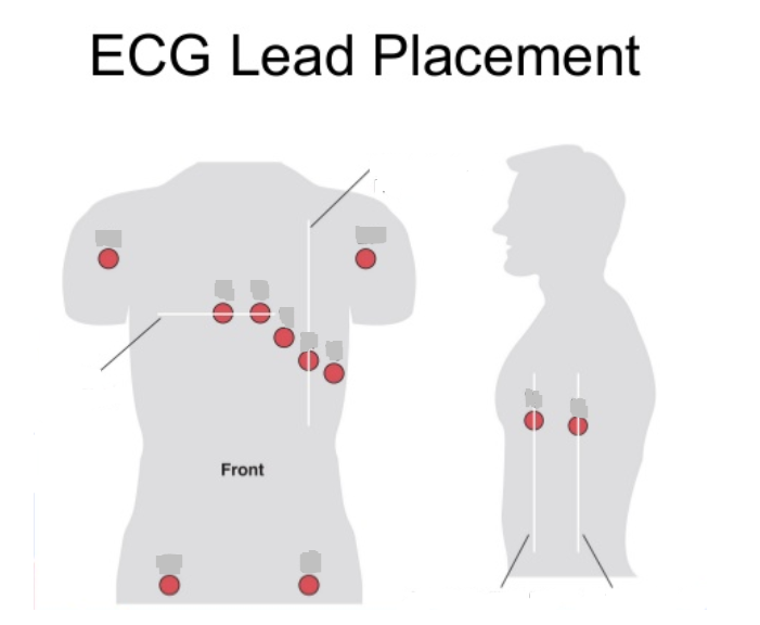 EKG class 2330 1st Test | Flashcards