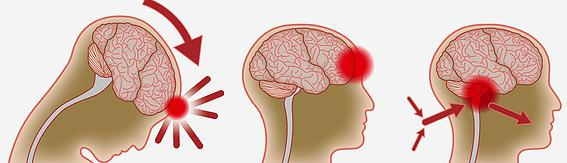 TRASTORNOS NEUROPSICOLOGICOS MAS FRECUENTES EN LOS TRAUMATISMOS ...