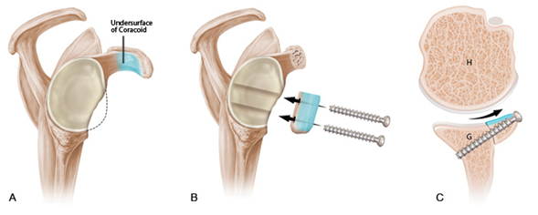 AVANCES CIENTÍFICOS Y/O TECNOLÓGICOS EN BIOMECÁNICA, PARA LA ...