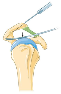 AVANCES CIENTÍFICOS Y/O TECNOLÓGICOS EN BIOMECÁNICA, PARA LA ...