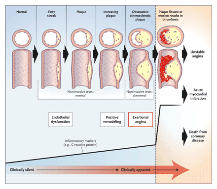 Atherosclerosis | Mind Map