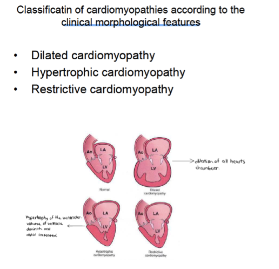 4th Pathoana Circulation Cardiomyopathies Flashcards