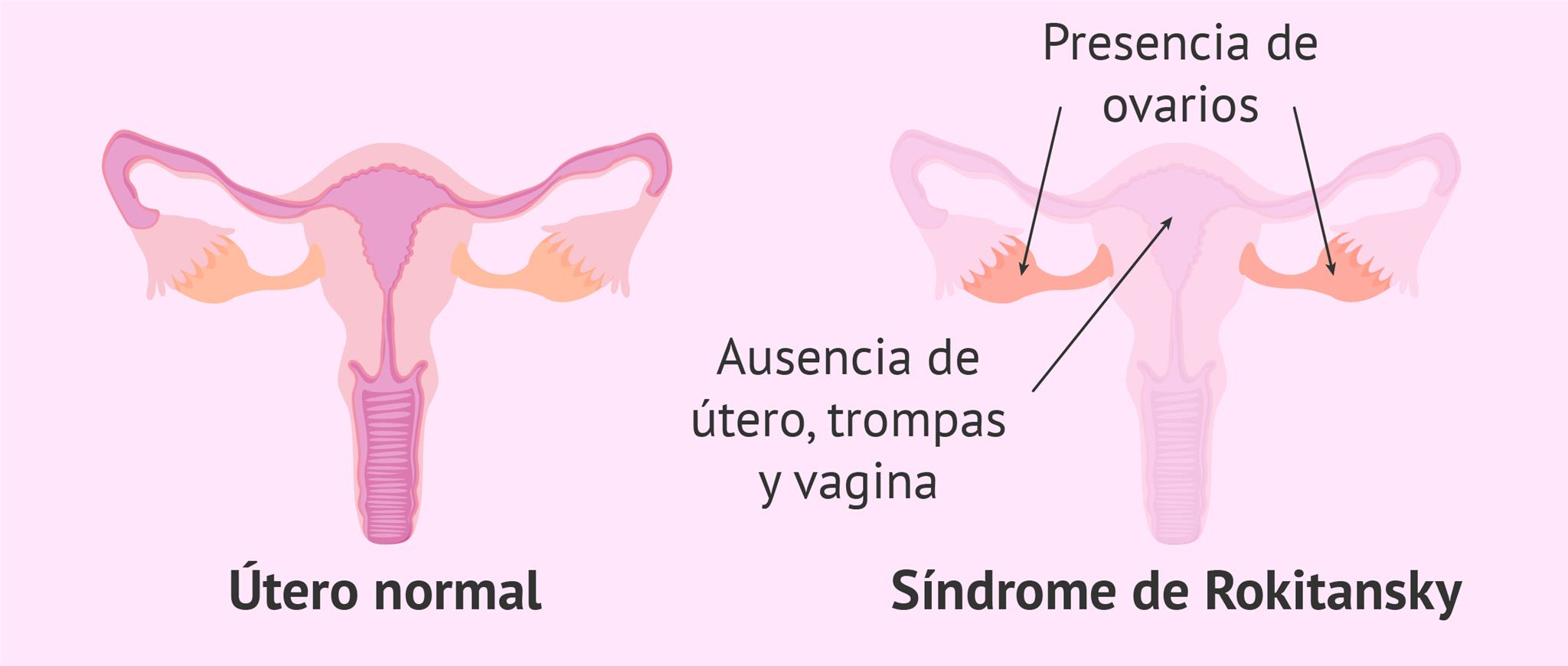 Anomalías Congénitas Del Aparato Reproductor Femenino Mind Map 8501