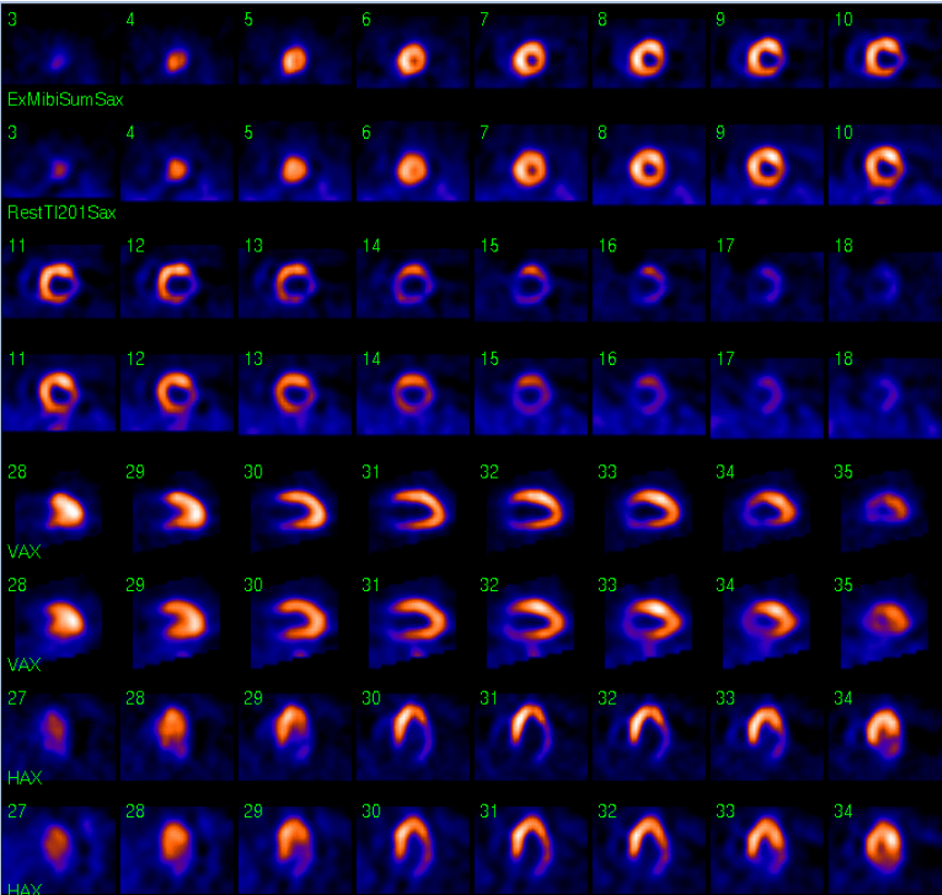 Cardiac - Myocardial Perfusion Imaging | Quiz