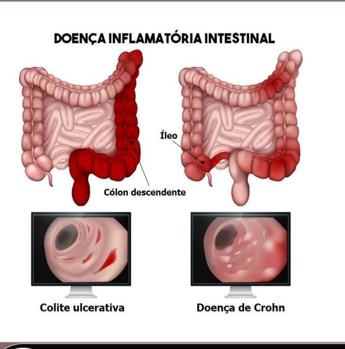 Doença Inflamatória Intestinal Mind Map 8522