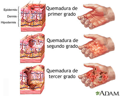 QUEMADURAS | Mind Map