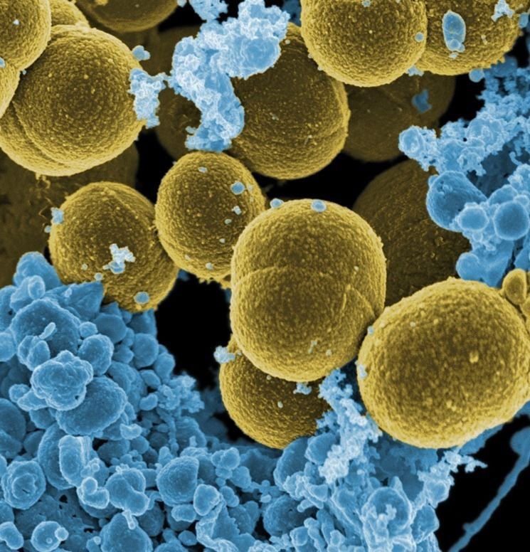 Infecciones Nosocomiales Por Staphylococcus Aureus En Pacientes ...