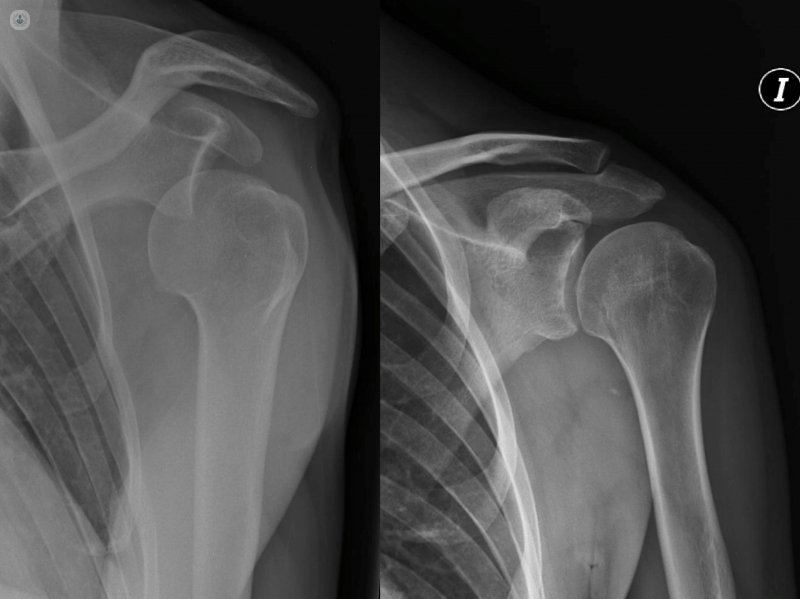 radiografía de hombro de rotación externa