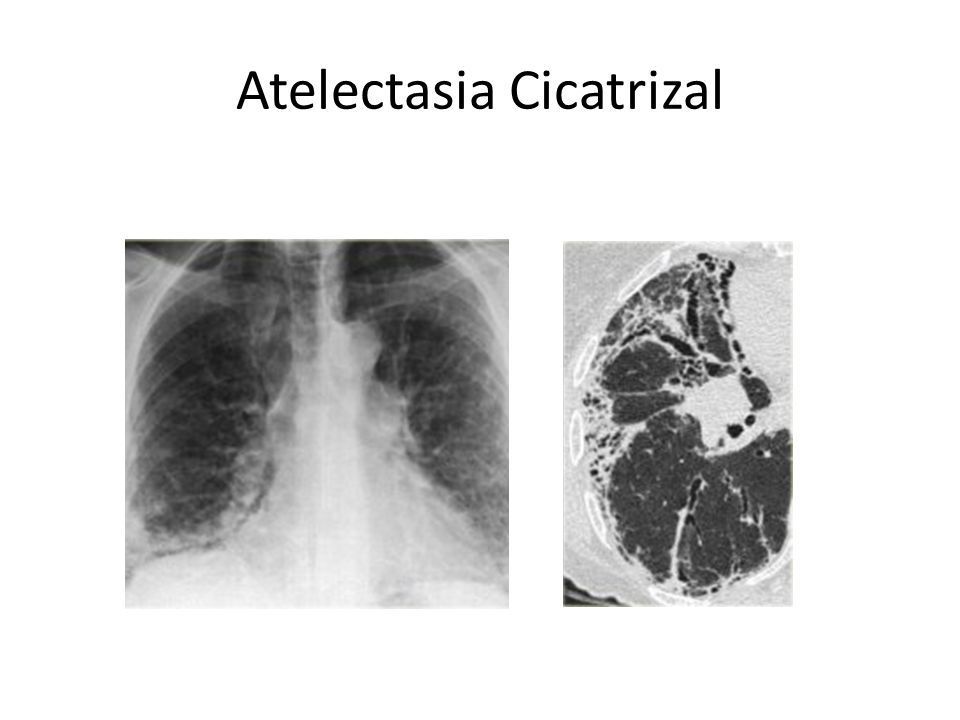 Atelectasia | Mind Map