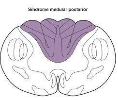 Mapa Sindromes Medulares | Mind Map