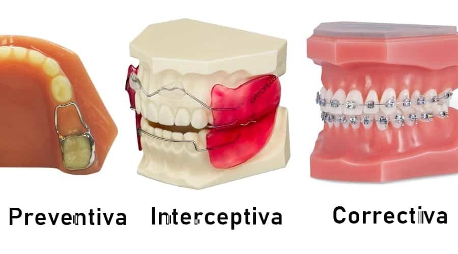 Ortodoncia Preventiva, Interceptiva Y Correctiva | Mind Map