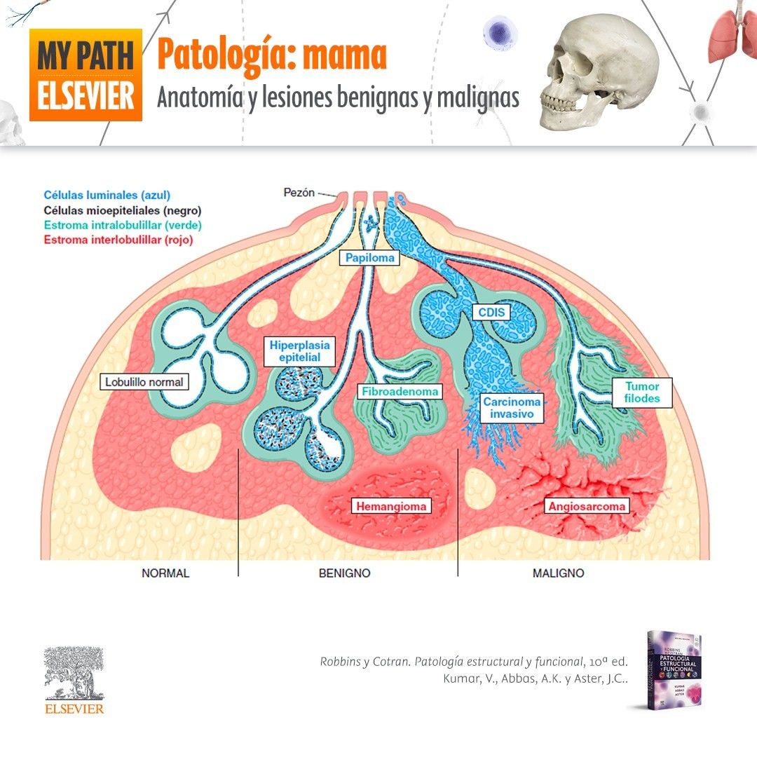 PatologÍas Benignas Y Malignas De La GlÁndula Mamaria Mind Map