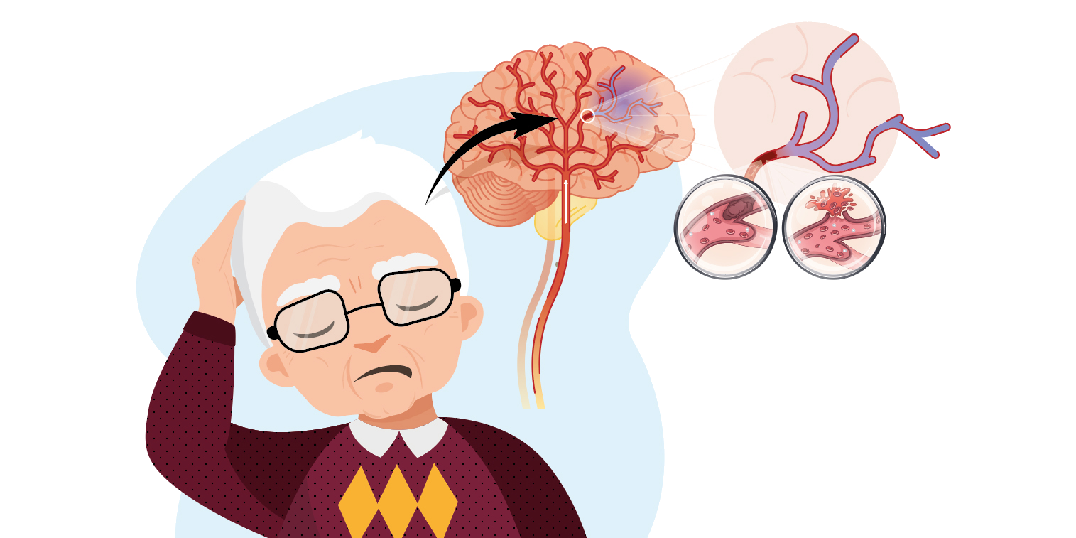 AVC - Acidente Vascular Cerebral | Mind Map