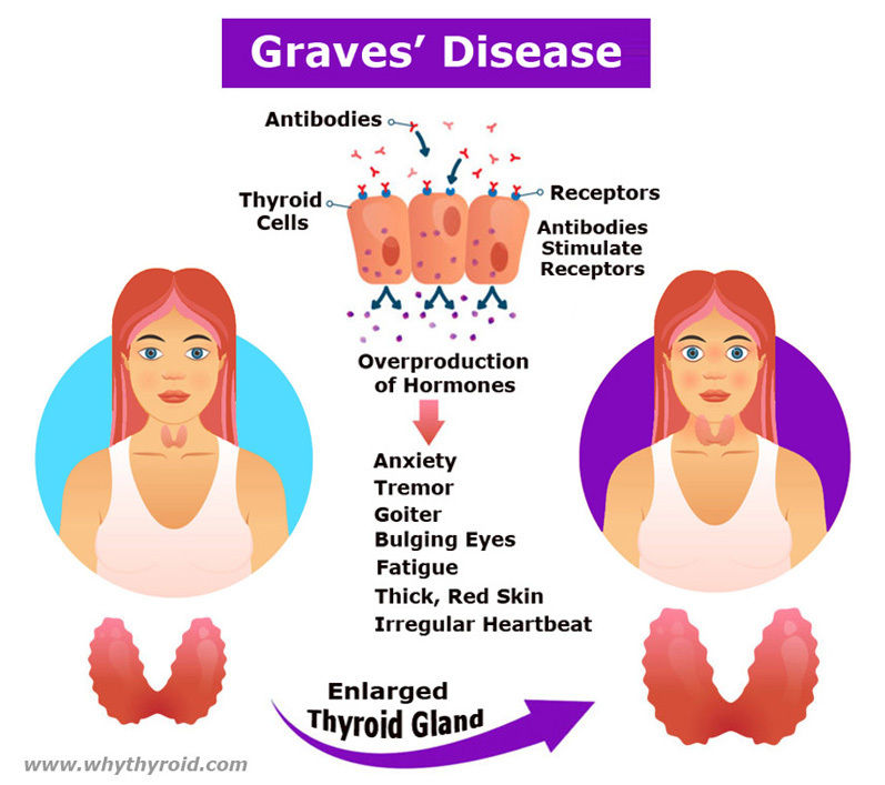 graves-disease-symptoms-onegravesvoice