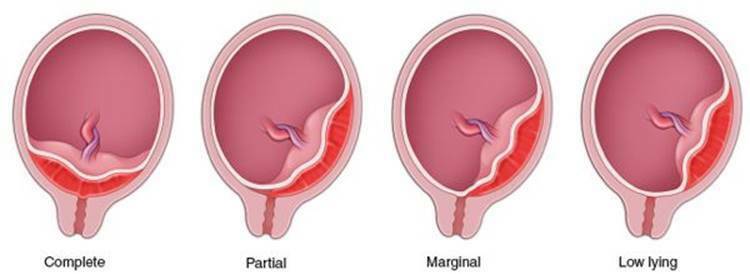 Clasificación de la placenta | Mind Map