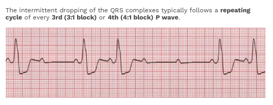 ECG Practice | Flashcards