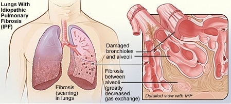 Image result for Pulmonary Fibrosis