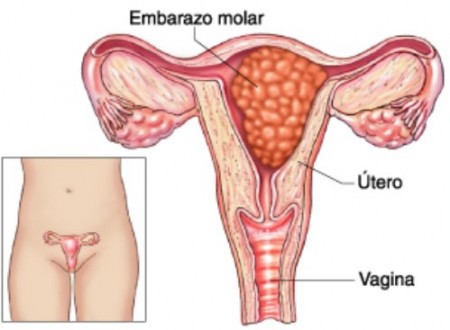 NEOPLASIA TROFOBLASTICA GESTACIONAL