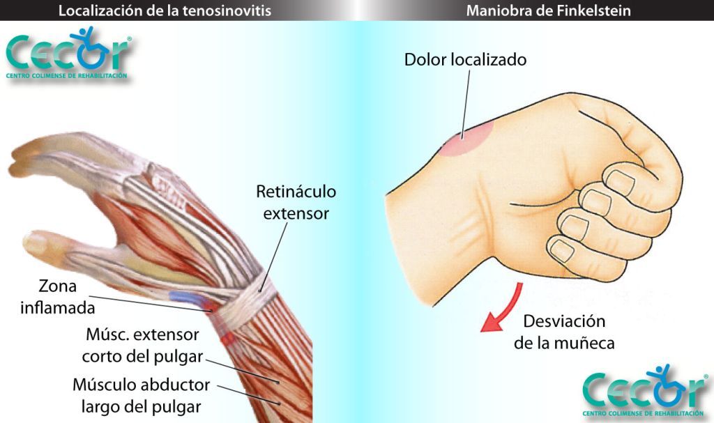 Tendinitis de Quervain – Ortopedia Castillo