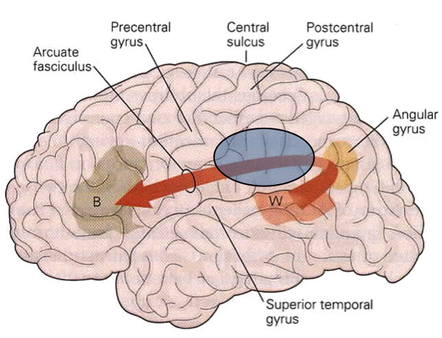 Aphasia meaning